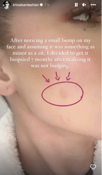 Khloe Kardashian is doing fine after having a tumour removed from her face, and has shared an update on her health.