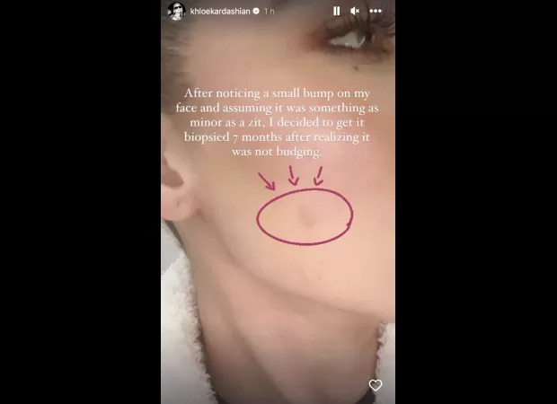 Khloe Kardashian is doing fine after having a tumour removed from her face, and has shared an update on her health.