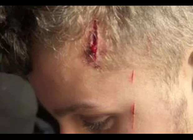 A 17-year-old boy was attacked at a house party, leaving him with facial lacerations.