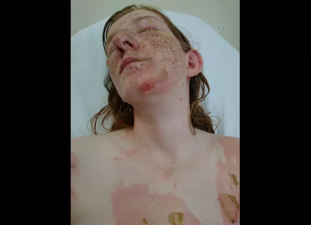 Mum's freckles disappeared after her brother-in-law threw boiling water on her.