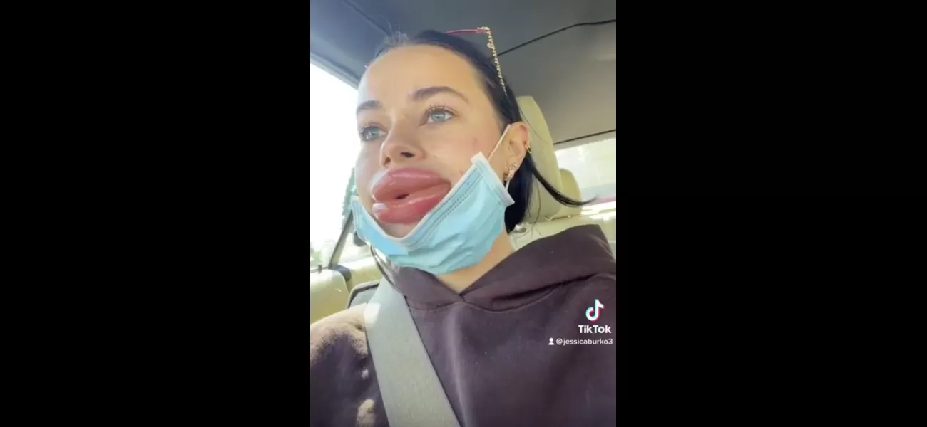 Woman warns others after lip filler treatment gone wrong made her lips 