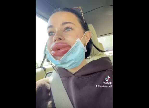 Woman warns others after lip filler treatment gone wrong made her lips 