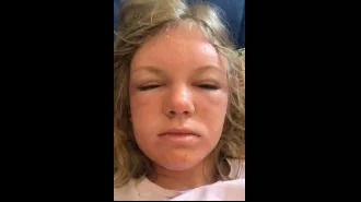 Woman experienced severely painful sun poisoning, appearing to be 