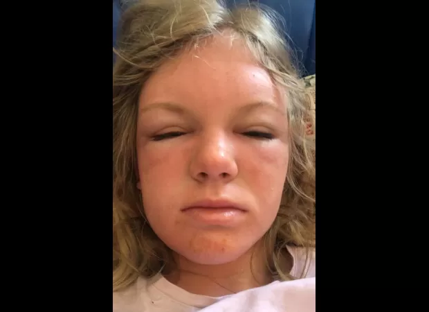 Woman experienced severely painful sun poisoning, appearing to be 