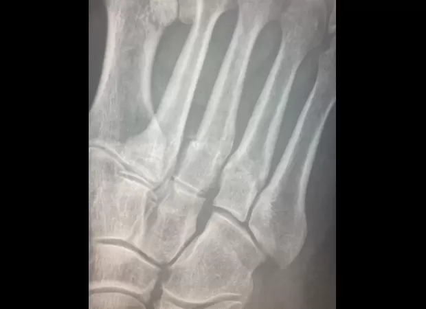 Denise Black, known for her roles in Coronation Street and Emmerdale, was rushed to the hospital with broken limbs.