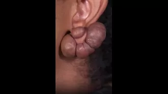 Woman's ears covered in large lumps resembling 