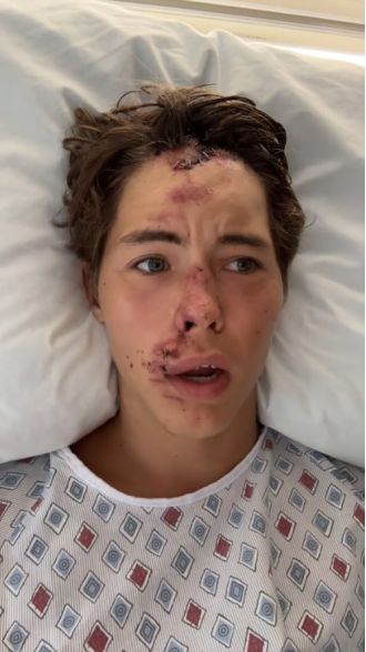 TikTok star feared death after falling onto lava rocks in Hawaii.