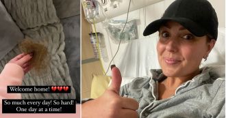 Amy Dowden shaved her head after experiencing severe hair loss.