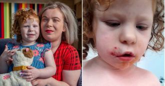 Girl, 12, suffers nightmares after being attacked by a dog, leaving her with lifelong scars.