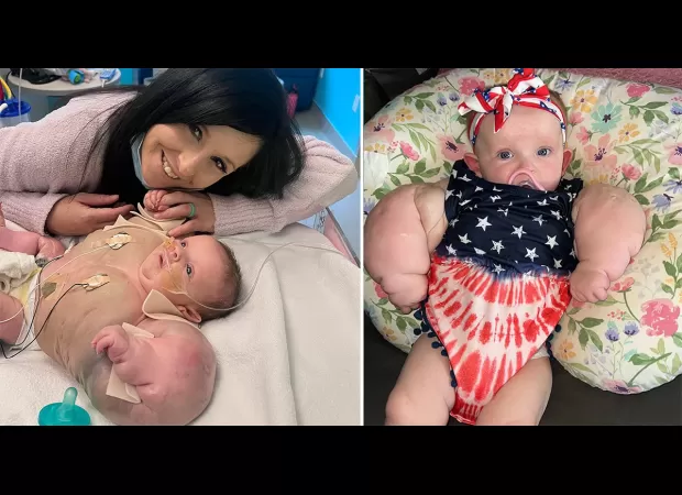 Girl born with large arms due to rare condition nicknamed 'Baby Hulk'.