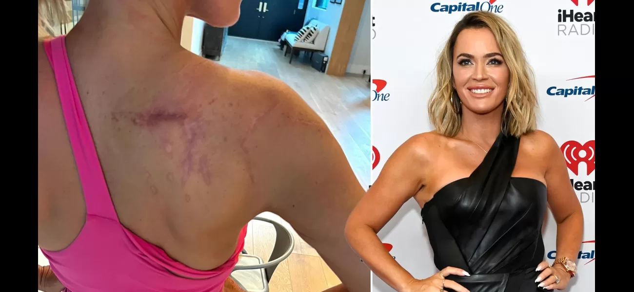 Teddi Mellencamp, 42, displays her cancer scars to raise awareness and support.