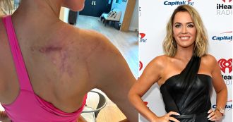 Teddi Mellencamp, 42, displays her cancer scars to raise awareness and support.