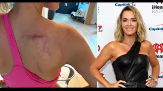 Teddi Mellencamp, 42, displays her cancer scars to raise awareness and support.