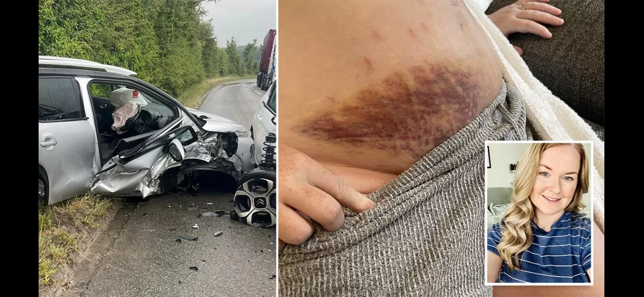 Mum involved in car crash while 38 weeks pregnant, resulting in large bruises on bump.