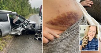 Mum involved in car crash while 38 weeks pregnant, resulting in large bruises on bump.