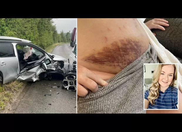Mum involved in car crash while 38 weeks pregnant, resulting in large bruises on bump.