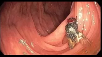 Doctors find mystery after discovering a live fly inside man's intestines.