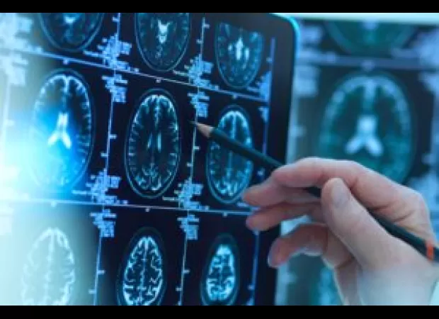 Blacks receive Alzheimer's imaging later in life than Whites, according to research.