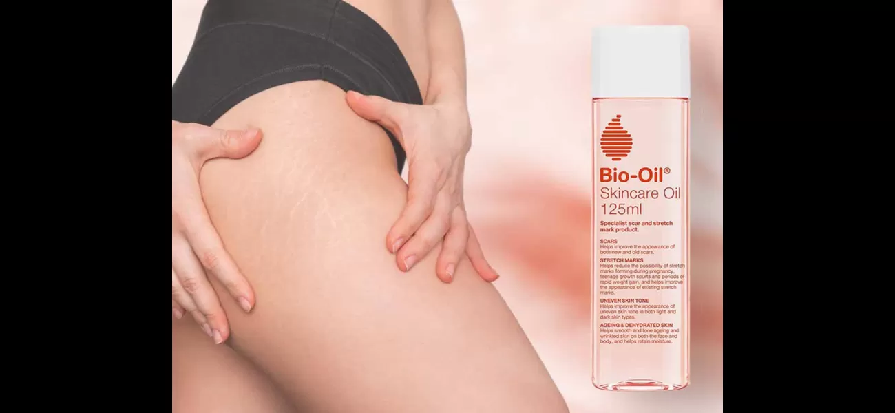 Say goodbye to scars! Get this body oil to reduce stretch marks and it's on sale now!