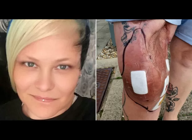 A simple scratch from a fishing hook led to 55 surgeries and the loss of half a leg.