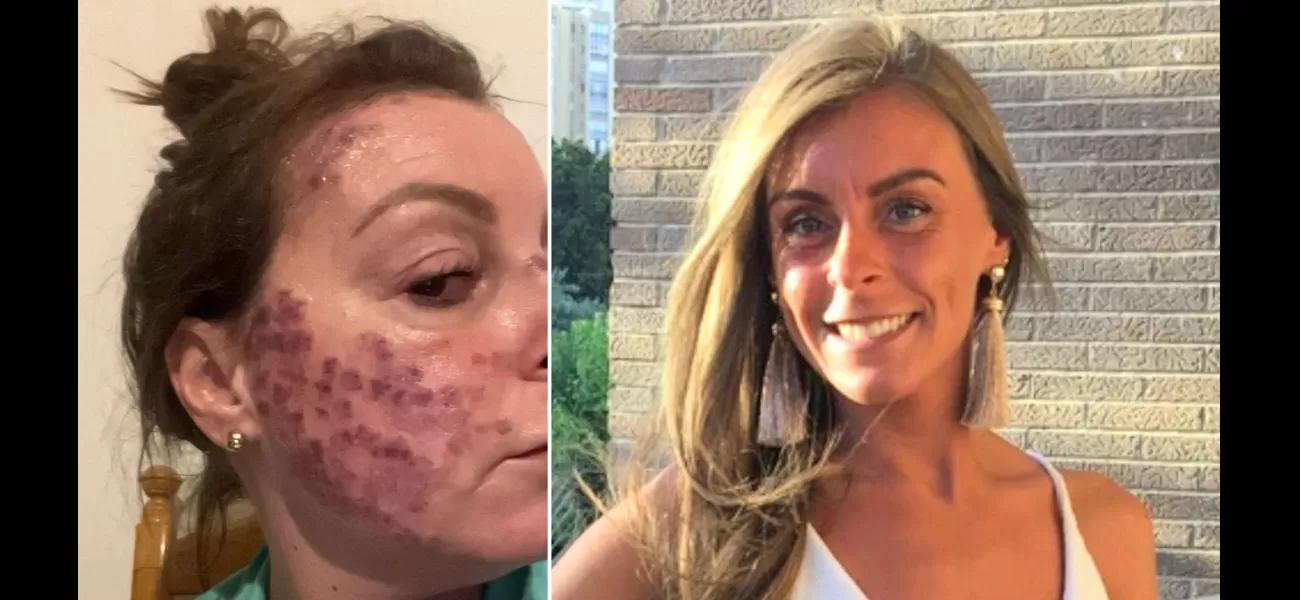 A woman's face covered in red marks from 15 years of tanning bed addiction.