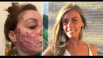 A woman's face covered in red marks from 15 years of tanning bed addiction.