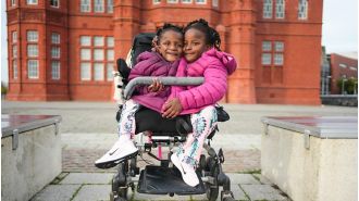 A new film delves into the incredible story of conjoined twins from Senegal.