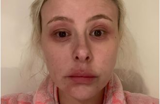 Eczema was a major issue for me, but I finally discovered a skincare regimen that has been incredibly effective.
