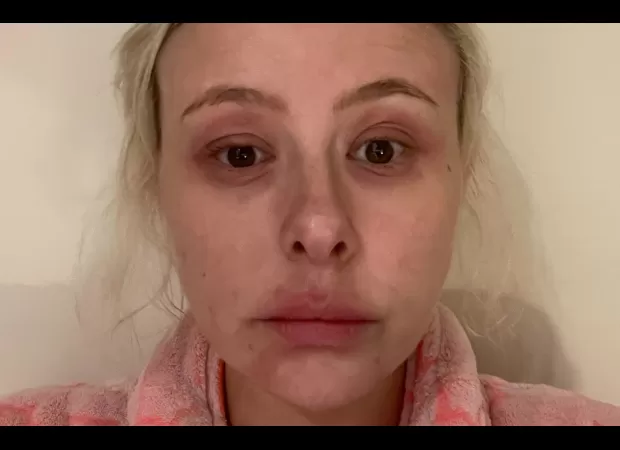 Eczema was a major issue for me, but I finally discovered a skincare regimen that has been incredibly effective.