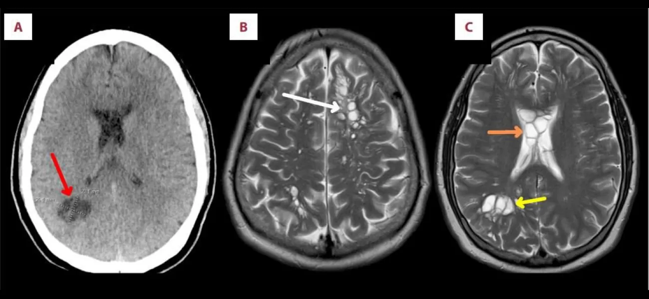 A man in Florida with chronic headaches had eggs living in his head.