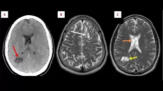 A man in Florida with chronic headaches had eggs living in his head.