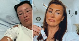 A 47-year-old woman hospitalized after using £25 'Barbie tan' drug.