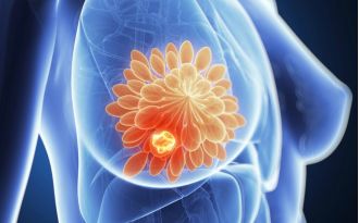 Promising breakthrough in breast cancer treatment eliminates dormant cells.