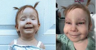 A 2-year-old girl was able to open her eyes for the first time after undergoing a life-changing surgery for a rare condition.