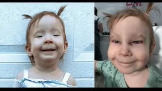 A 2-year-old girl was able to open her eyes for the first time after undergoing a life-changing surgery for a rare condition.