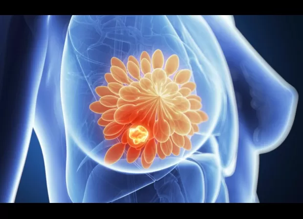 Promising breakthrough in breast cancer treatment eliminates dormant cells.