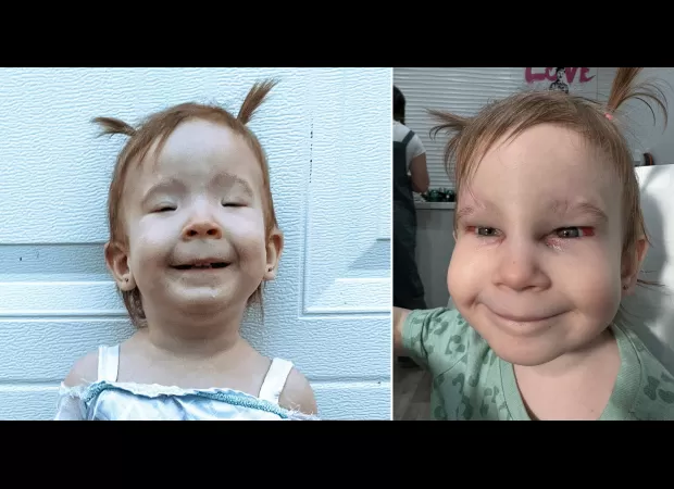 A 2-year-old girl was able to open her eyes for the first time after undergoing a life-changing surgery for a rare condition.