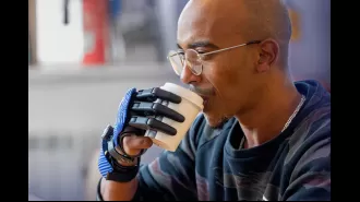 A man injured by a meat grinder receives new bionic fingers made with a 3D printer.