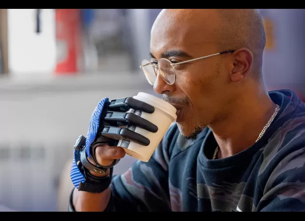A man injured by a meat grinder receives new bionic fingers made with a 3D printer.