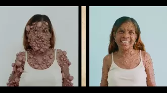 Rare condition causes woman to have thousands of tumours, but surgery allows her to see her face once more.