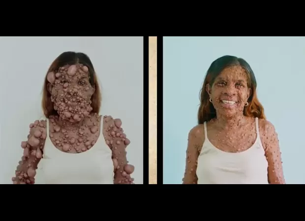 Rare condition causes woman to have thousands of tumours, but surgery allows her to see her face once more.