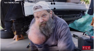 Man overcomes obstacle to have facial tumor removed.