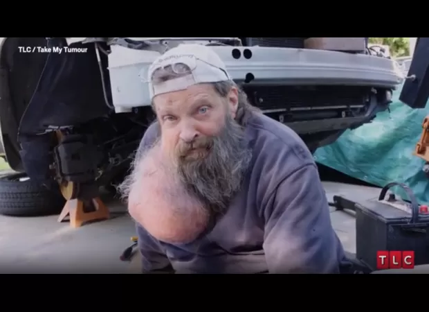 Man overcomes obstacle to have facial tumor removed.