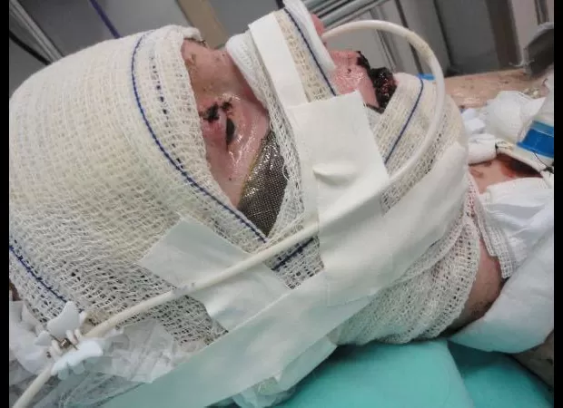 Woman experiences severe internal burning from using ibuprofen for menstrual cramps.