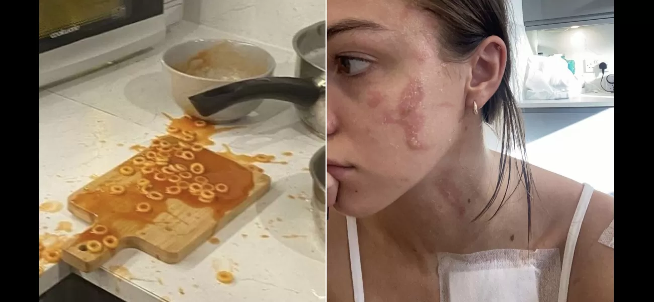 Woman injured by exploding can of Heinz spaghetti hoops, resulting in facial burns.