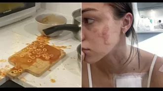 Woman injured by exploding can of Heinz spaghetti hoops, resulting in facial burns.
