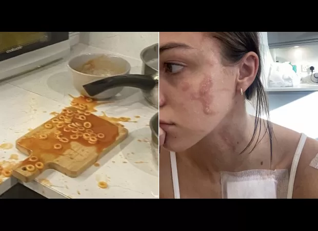 Woman injured by exploding can of Heinz spaghetti hoops, resulting in facial burns.