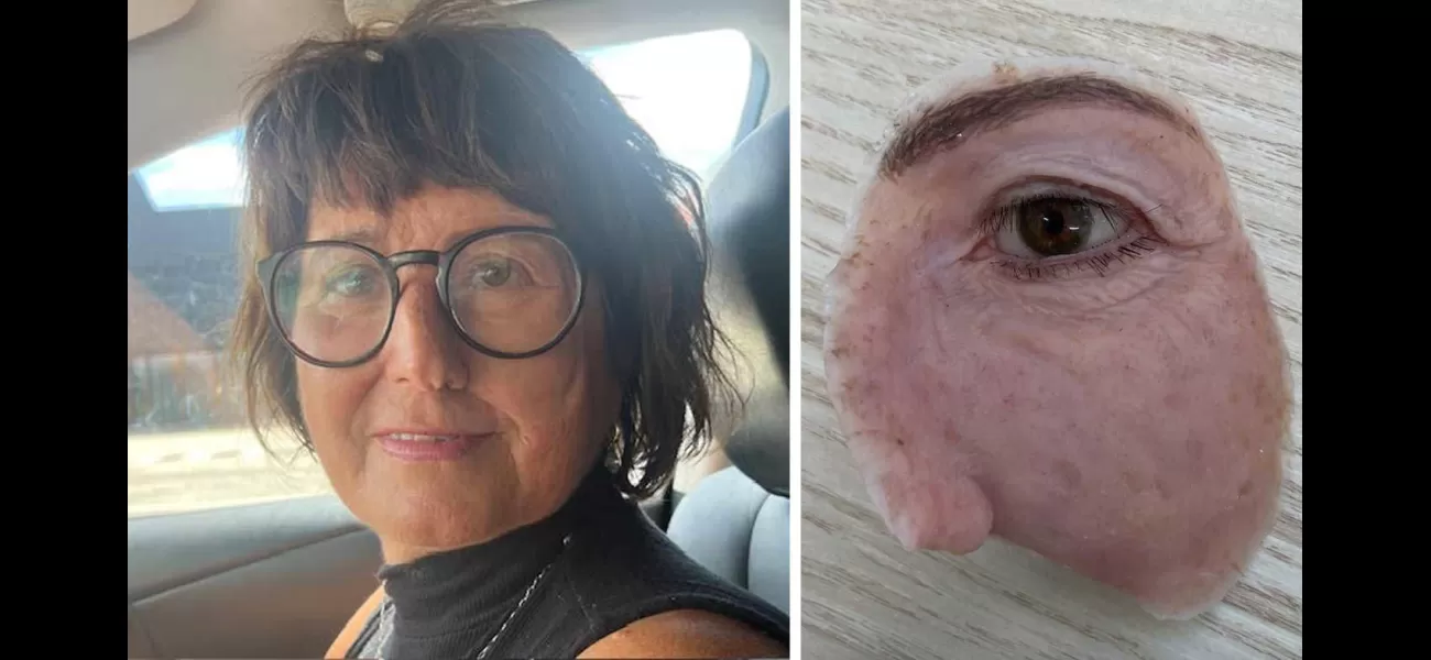 Tracey had her eye removed due to cancer, but her artificial replacement was deemed only for appearance.