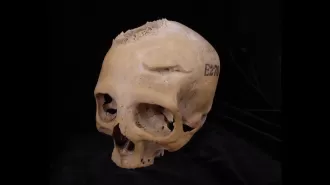 4,000-year-old Egyptian skull may have evidence of ancient cancer treatment.