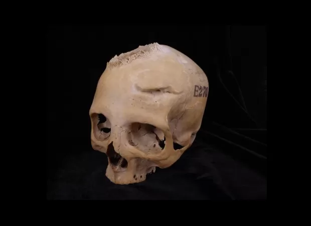 4,000-year-old Egyptian skull may have evidence of ancient cancer treatment.